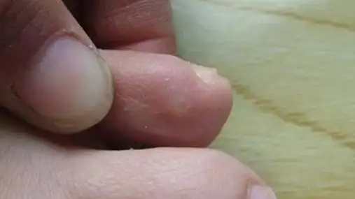 鸡眼的重要症状3,长鸡眼是什么真相4,鸡眼的有效医治方法鸡眼初期的