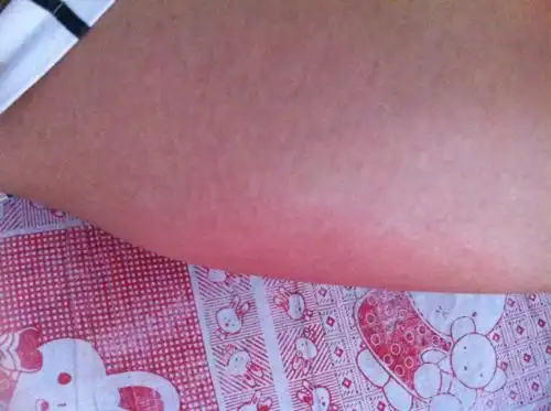 应晓丽 医师 两周前包皮开始瘙痒,长疙瘩,然后就散发到大腿内侧