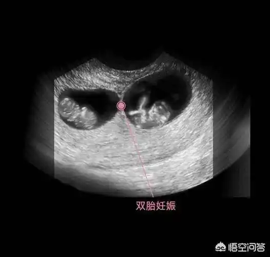 双胞胎,因为它有两个胎囊,需要等胚胎出现胎心和胎芽,也就是要9周左右
