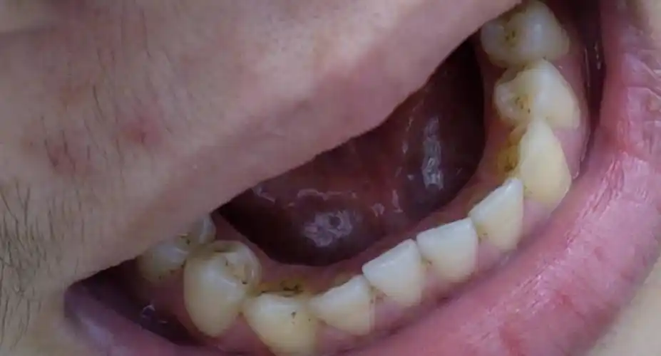 答: 这个和自身的体质有关系的,还有水质也是有关系的,还是建议洗牙