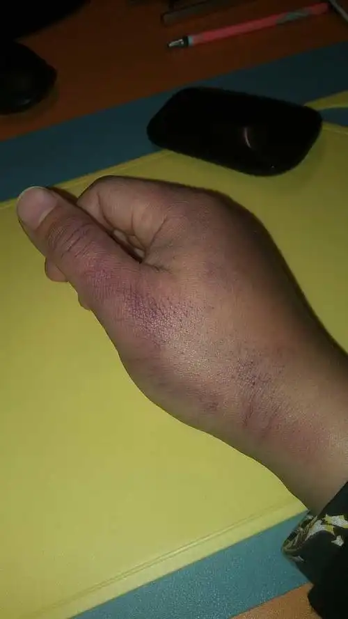 $安控科技(sz300370)$ 打架把手打肿了,今天手一抖就把单子撤了,撤了