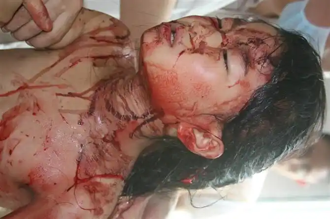 五龙镇入室抢劫凶残砍伤8岁女童35刀