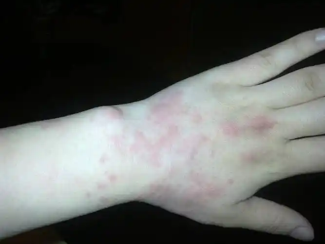 医生送你4个小妙招_过敏原_症状_过敏性