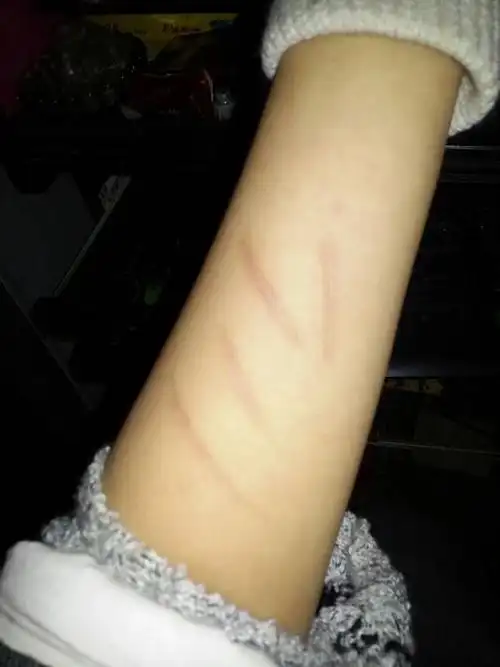 怎么才能去除手臂上的疤痕有三个月了吧