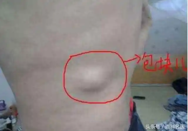 脂肪瘤是怎么引起的怎么判断脂肪瘤是良性还是恶化