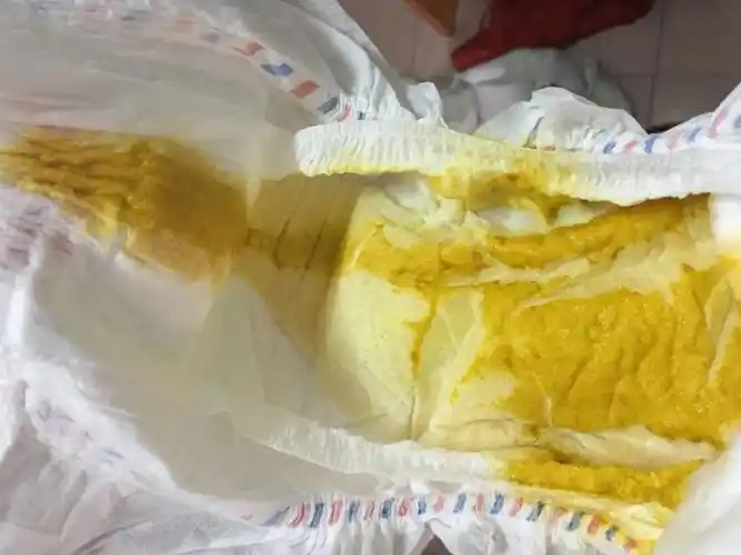 出院后喉咙有痰,痰粘,嘴巴两侧有鹅口疮一直有,便便有奶瓣,水便分离