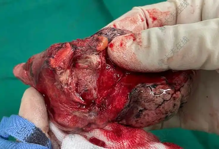 左上s1 2切除_肺部结节 - 好大夫在线