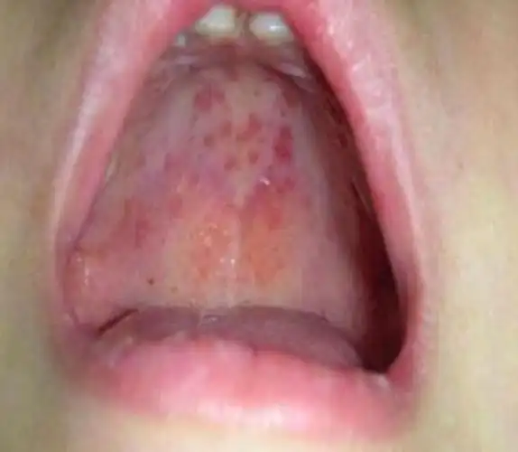 婴幼儿手足口早期图片图片_有来医生