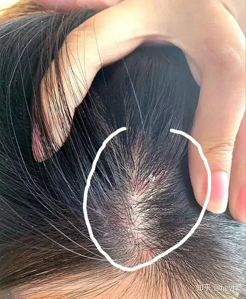 我就之前就是头皮屑特别多,头还很痒,油不拉叽的,天天在头上都能扣