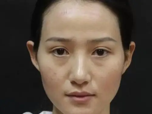 我的五官不够饱满立体,脸颊也有点凹陷,就给人的视觉_圈子-新氧美容