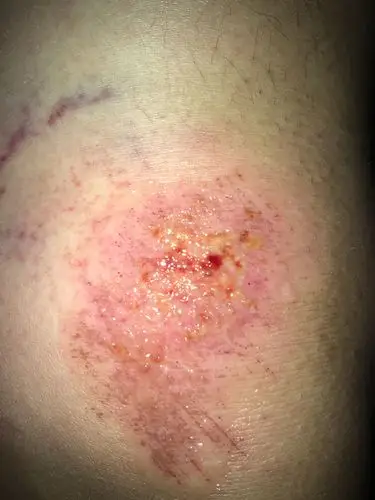 我昨天膝盖摔倒在了柏油路上,伤口好像挺深的.