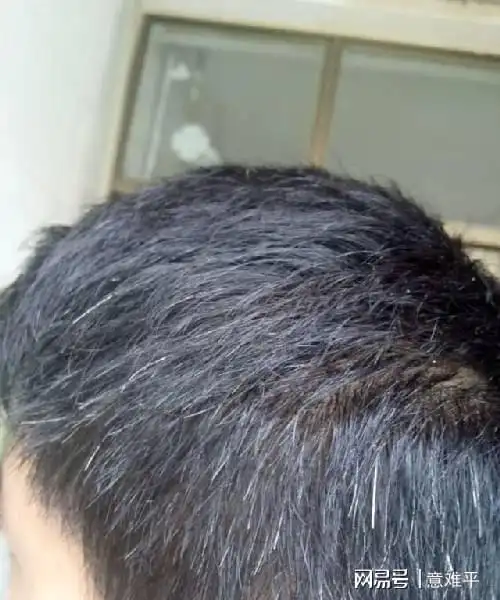 少白头是缺乏维生素白头发会拔一根长十根医师告诉你答案