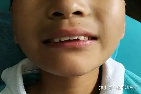 龅牙怎么办?可以矫正吗?