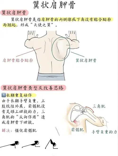 翼状肩胛是指肩胛骨内侧缘和下角离开胸壁,出
现如翅膀样的畸形,可