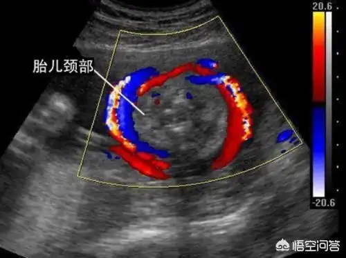 胎儿脐带绕颈,看胎儿的b超图像,胎儿的颈部会有u型压迹,超声提示会