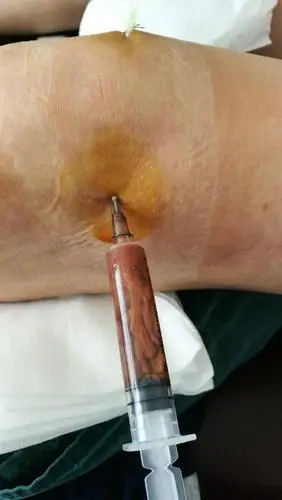 膝盖积水用烤灯能烤好吗?粗盐呢?医生:明确诊断针对治疗是关键