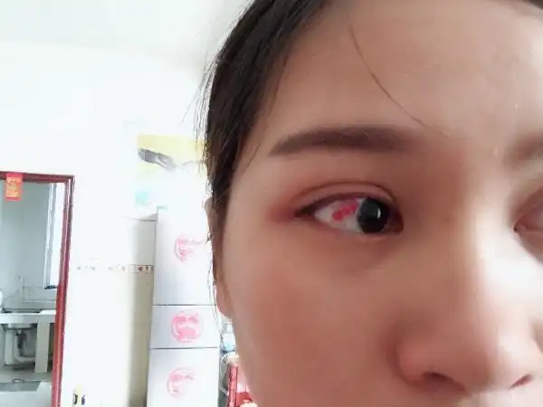 如何让哭肿的眼睛消肿_如何让哭肿的眼睛消肿最快的方法-awzn.cn