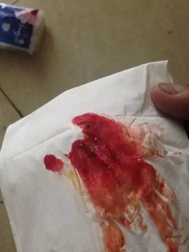 上大号的时候会出血,貌似有点严重,肛门有点痛,刚刚拉出来的很干,血是