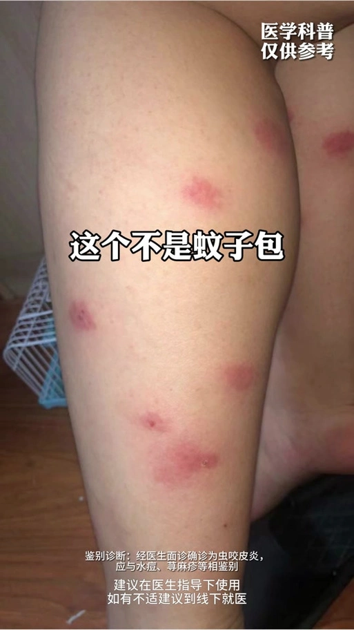 被不知名的虫子叮了红肿痒怎么办 - 抖音