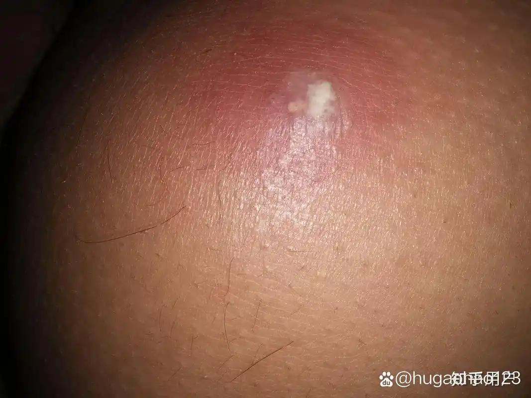 屁股上长火疖子有没有什么妙法解决