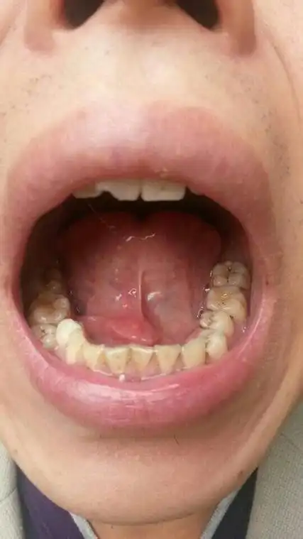 舌头下面长个肉坨,偶尔会痛!