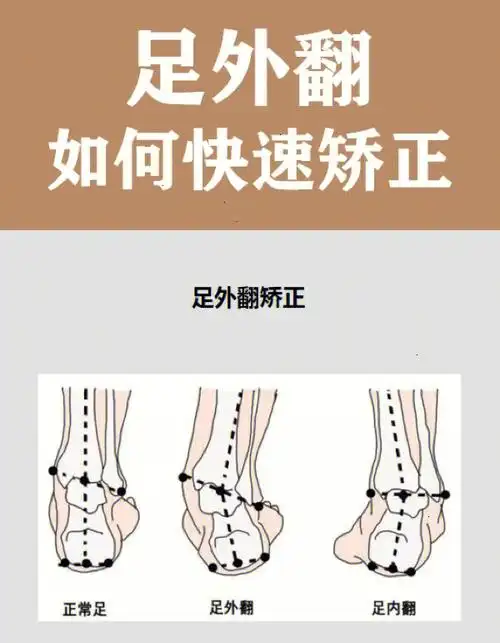 足外翻如何快速矫正