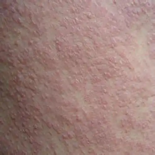 手臂起红色丘疹图片