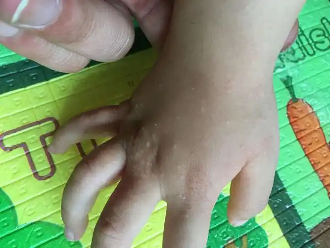 宝宝手上长了这些一粒一粒的是什么呀?