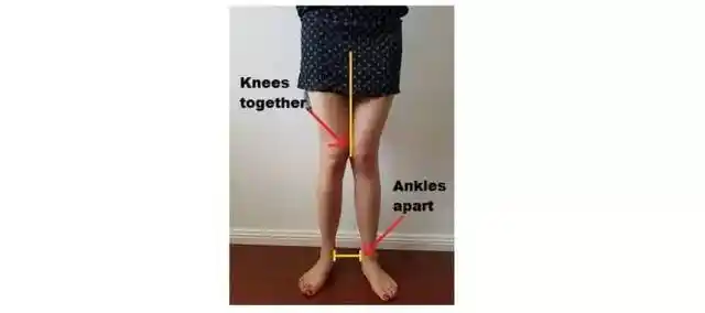 自测膝盖内扣:直立站姿,双腿并拢.