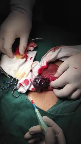 科普:睾丸扭转14岁少年骑单车碰到"蛋蛋"因羞涩延误就诊,导致一侧睾丸