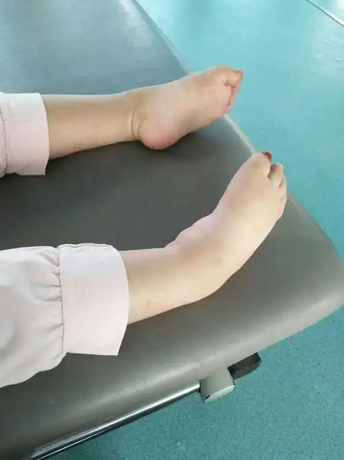 13岁患儿,双踝关节趾屈内翻畸形,无法正常站立.