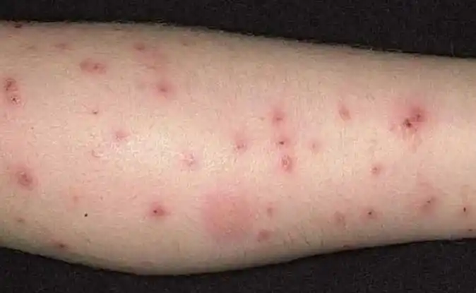 治疗|医院|瘙痒|蜘蛛|叮咬|-健康界