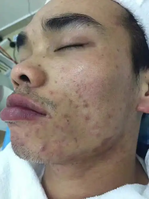 用手挤痘痘后留下的疤痕怎么去除