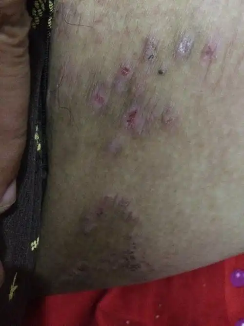 (找皮肤大夫)大腿内侧瘙痒,皮肤发黑,这是什么病?