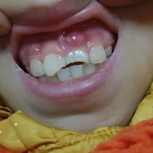 多生牙怎么拔除