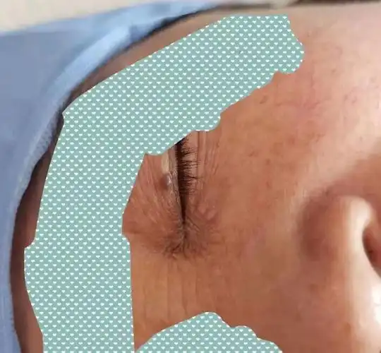 有"痣"青年注意了,要分清好坏