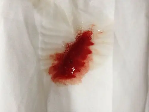 咳血是什么毛病呢