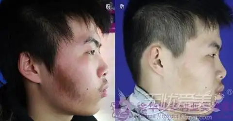在金华维多利亚做激光祛贝克痣让他不再当浙师大金刚狼