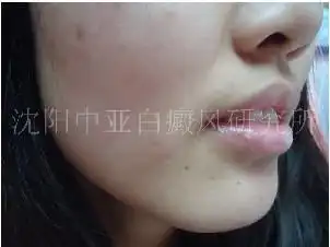 门诊病例:16岁女性面部白癜风患者_沈阳中亚白癜风研究所
