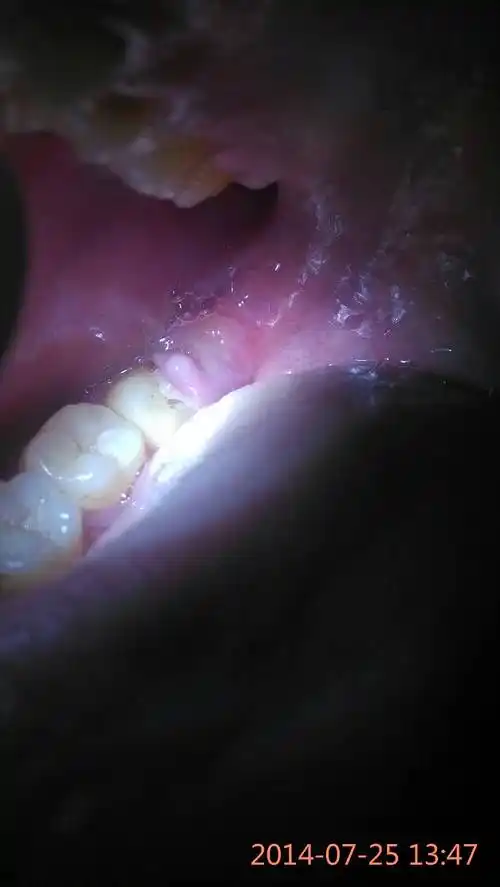 2014-06-10 邓立民 医师助理 智齿,导致急性牙痛,牙龈肿痛.