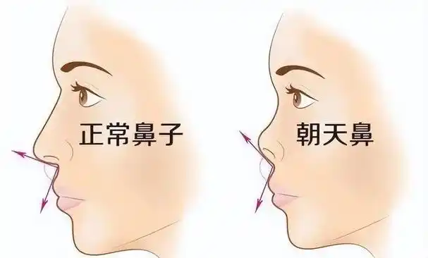 鼻子塌不算什么,"鼻孔外露"才拉垮,显老又显凶,太多人遭殃