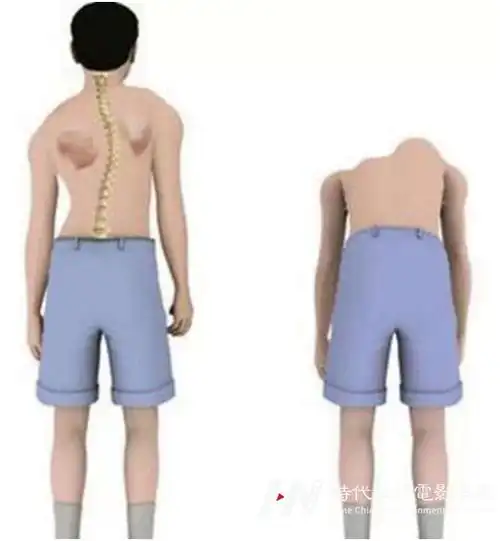 深圳少儿模特形体矫正机构-孩子驼背怎么办