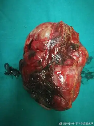 这是邵永孚去海南为病人切除的部份恶性肿瘤,如有不适望不要观看.