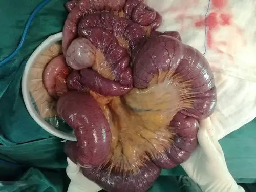 2018年12月第一台急诊开腹手术急性肠梗阻,小肠扭转致腹内疝急诊手术