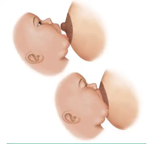 衔乳即婴儿用嘴紧吸乳头及周围深色乳晕(图 1).