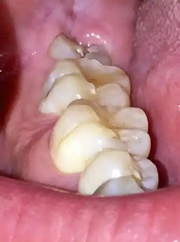 长了一颗智齿(牙齿部分没有全露出来,大部分在牙龈里)要拔吗?