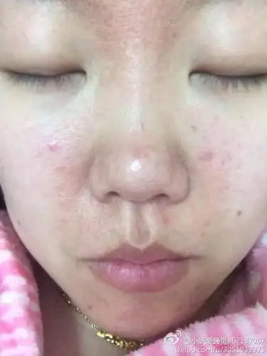 朱大夫,脸上个月过敏好了以后就经常这样,痒痒的还有包,我一直在?