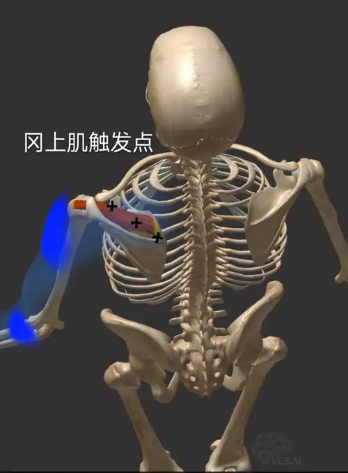 一,冈上肌触发点