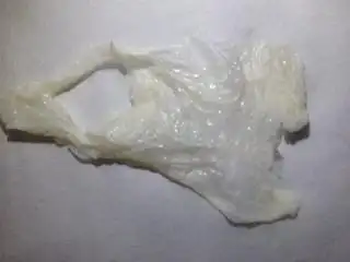 前2天白带偏多,白色的水样状,就用洗液冲洗了阴道一次,之后阴道里出现