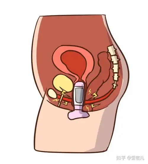 爱密儿产后子宫脱垂每个女人都应预防